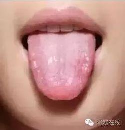 为什么吃瓜吃舌头会烂,吃瓜为何会导致舌头烂掉的原因