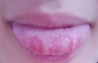 为什么吃瓜吃舌头会烂,吃瓜为何会导致舌头烂掉的原因