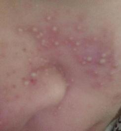 吃瓜上颚特别痒,揭秘吃瓜上颚奇痒之谜