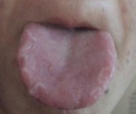 吃瓜上颚特别痒,揭秘吃瓜上颚奇痒之谜  第3张